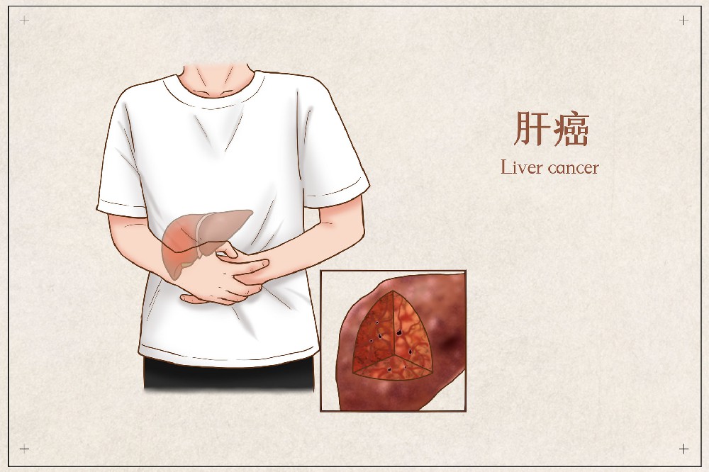 摄图网_401794893_banner_肝癌医疗插画(企业商用).jpg