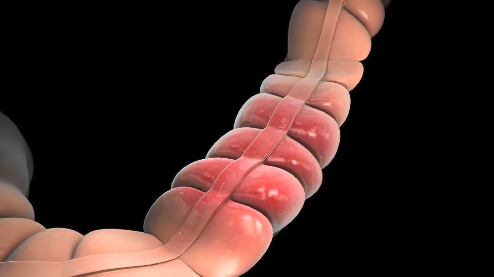 肠癌术后别乱吃,这 3 类食物易堵肠道!