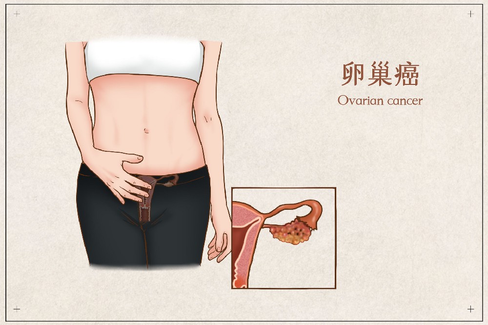 成都平安肿瘤医院樊君：卵巢癌早期症状！