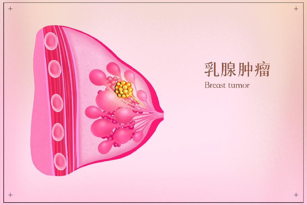 成都平安肿瘤樊君：乳腺结节会消失吗？