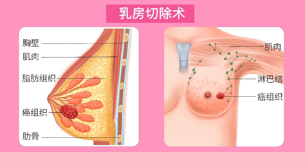 身体发出的这些信号，是乳腺癌复发转移的表现，千万不能忽视