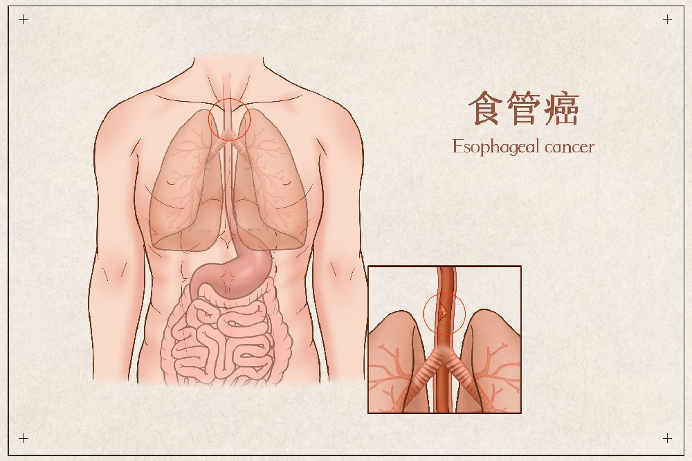 食道癌早期信号！