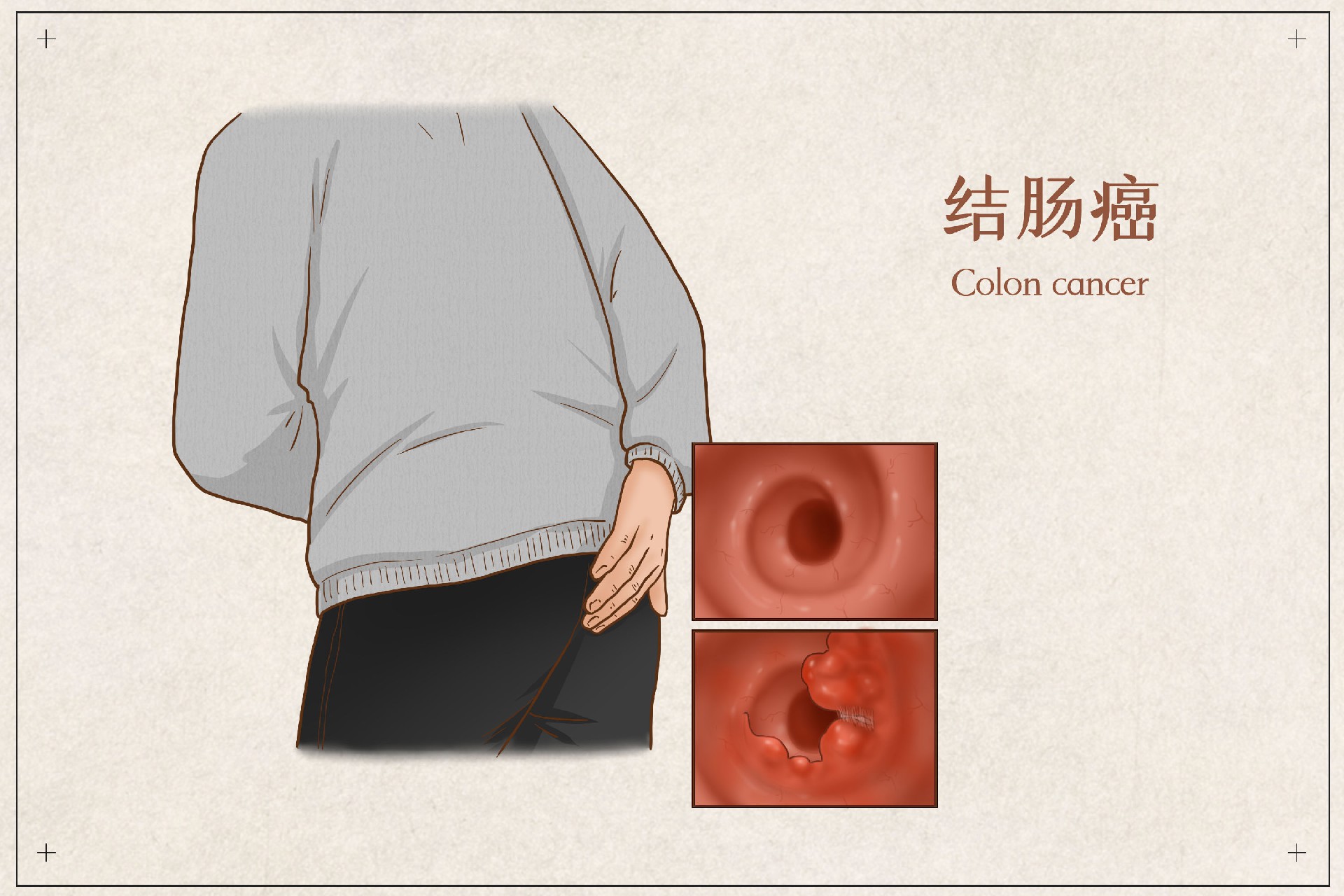 摄图网_401799670_结肠癌医疗插画（企业商用）.jpg