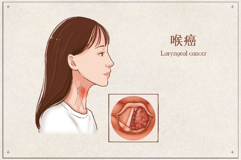 喉咙不舒服，一颗润喉糖就解决？别大意，小心是喉癌！