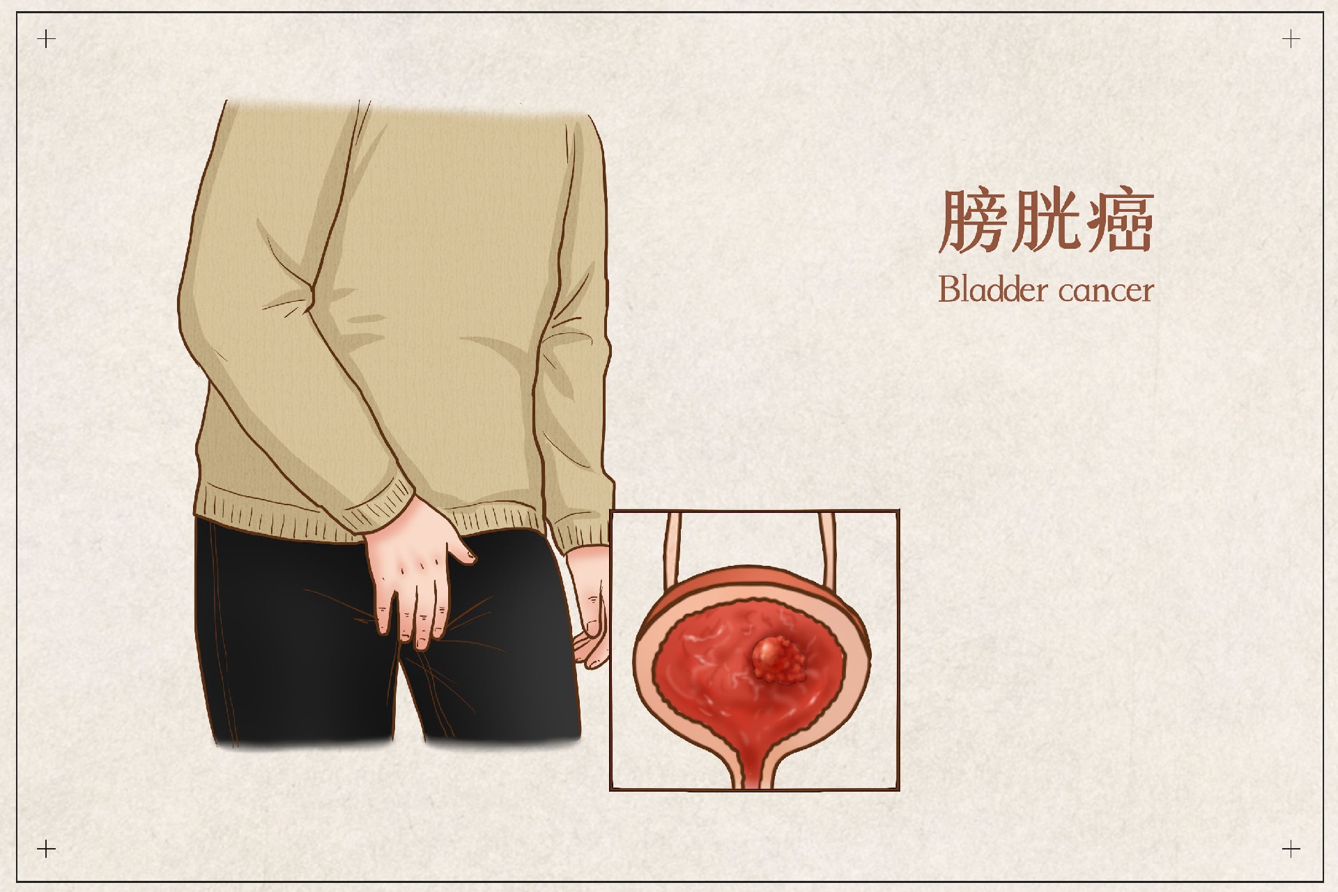 摄图网_401802457_膀胱癌医疗插画（企业商用）.jpg