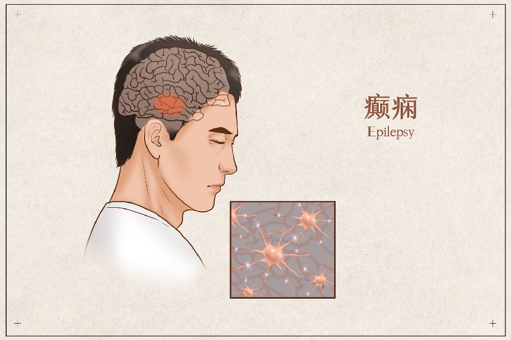 什么是癫痫？癫痫发作怎么办？