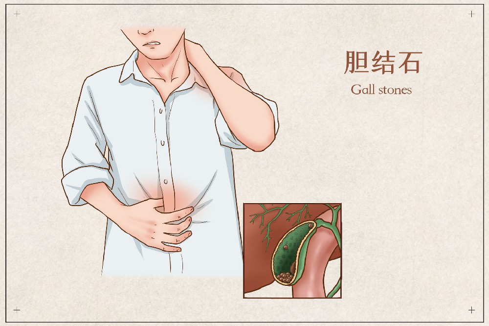 胆结石怎么引起的原因有哪些？