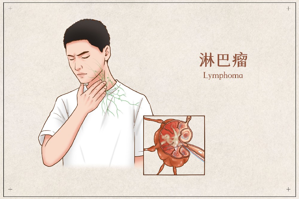 赵春天主任：淋巴瘤不手术只化疗可以吗？