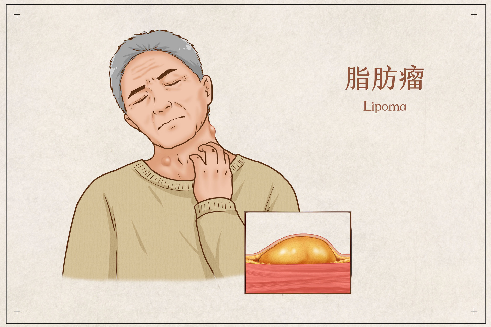 摄图网_401800685_banner_脂肪瘤医疗插画（企业商用）.jpg