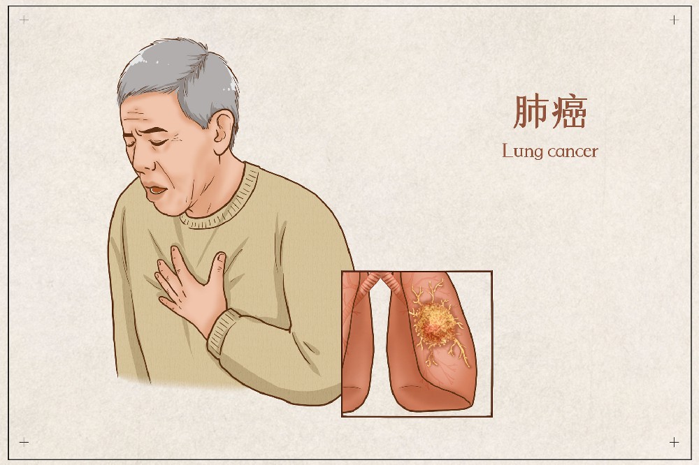 赵建华主任：肺癌早筛、早防、早诊治，中医药参与全过程