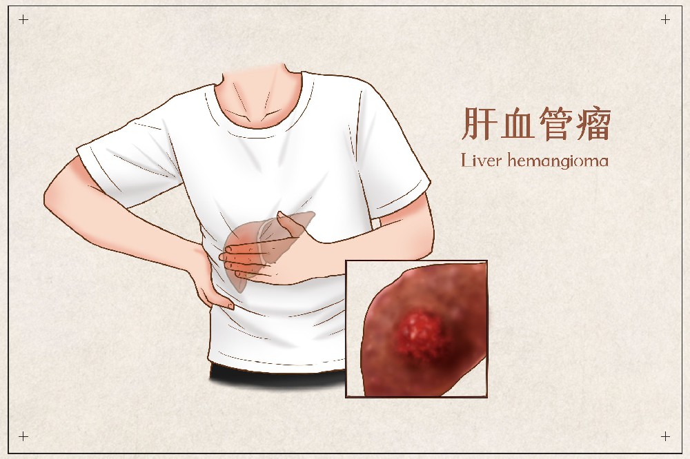 樊君主任：肝血管瘤是什么？会不会发生癌变？