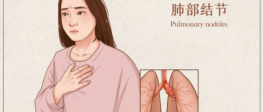 樊君主任：体检查出肺结节，严重吗？该怎么办？