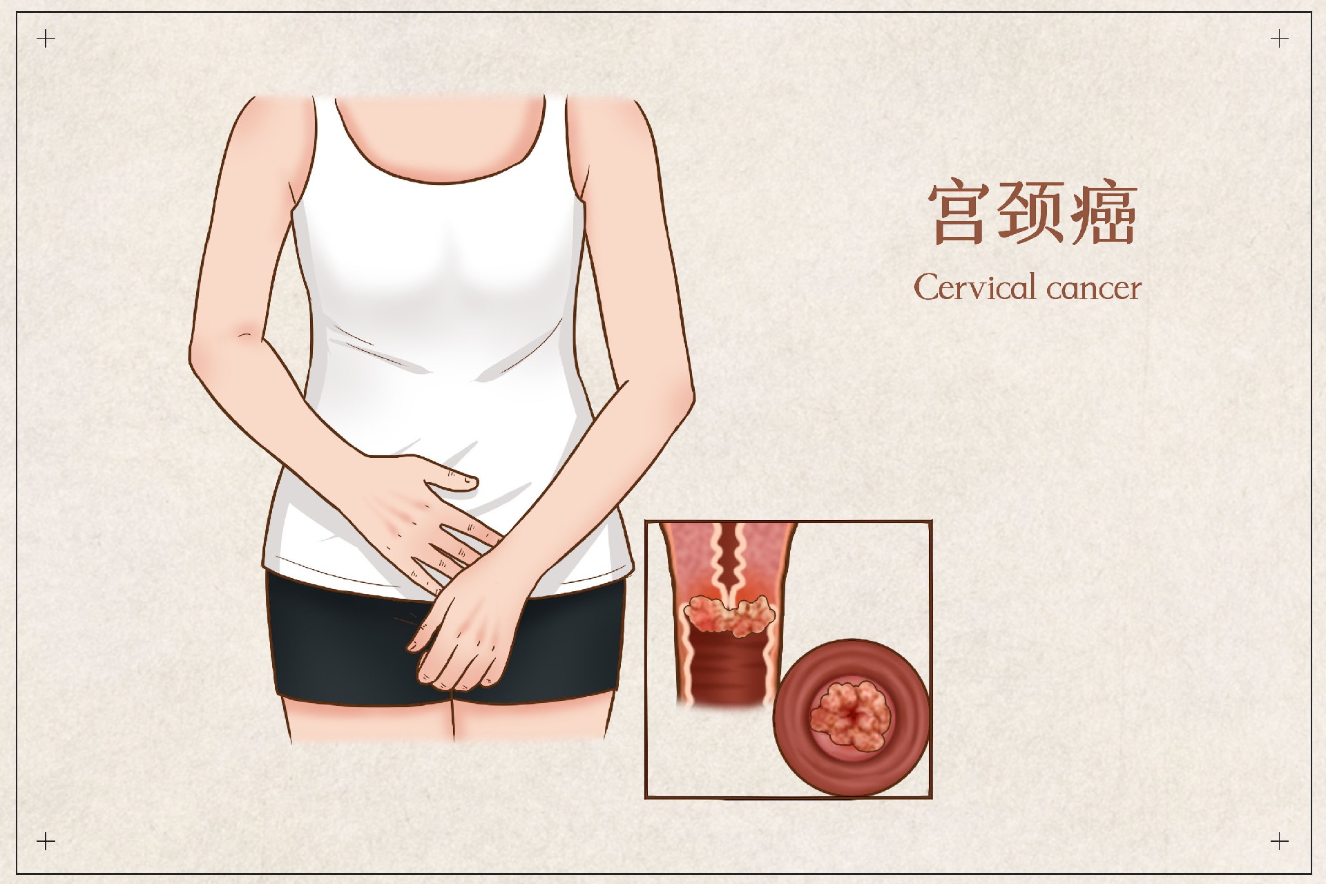 摄图网_401800680_宫颈癌医疗插画（企业商用）.jpg