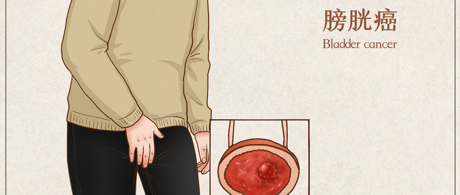 摄图网_401802457_wx_膀胱癌医疗插画（企业商用）.jpg