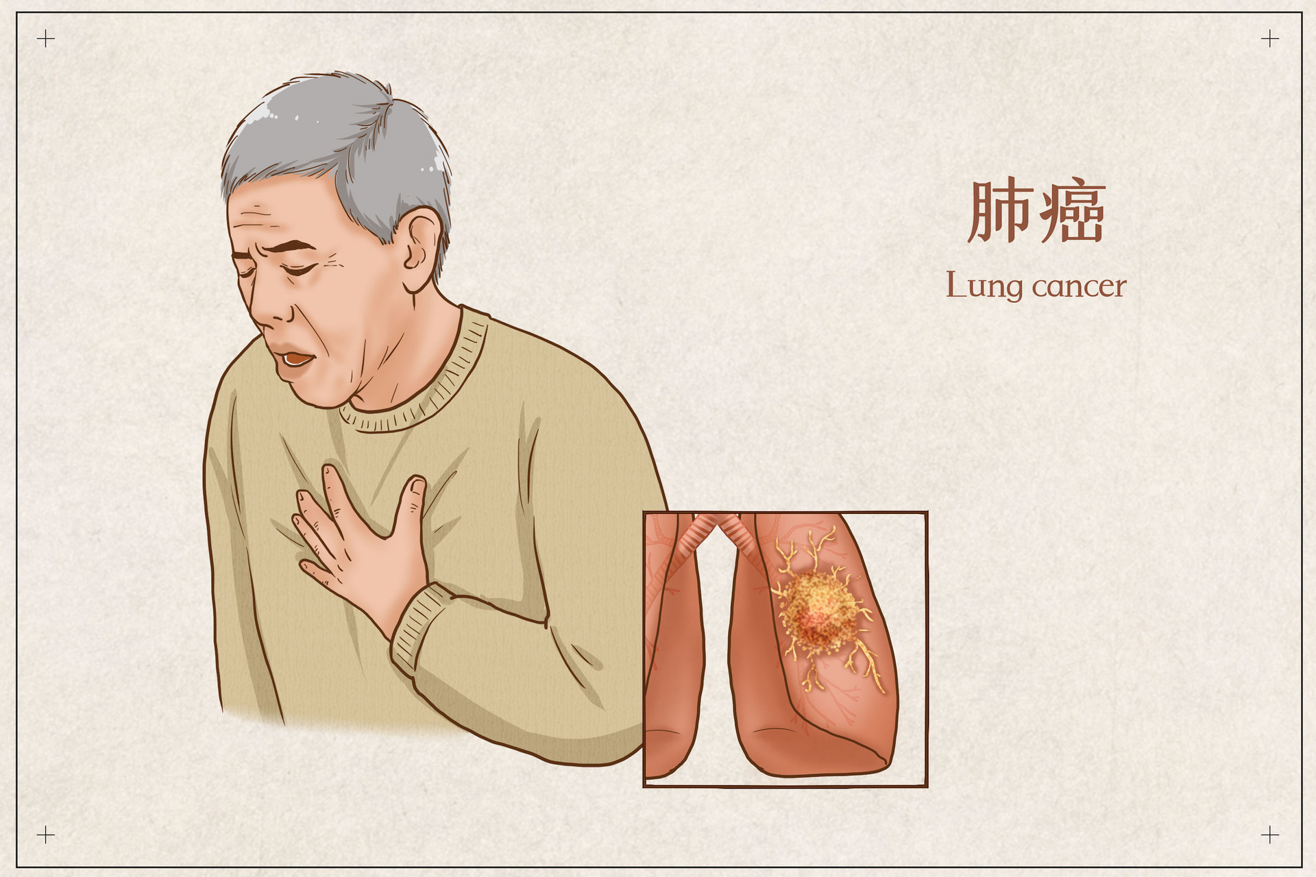 摄图网_401800683_banner_肺癌医疗插画（企业商用）(1).jpg