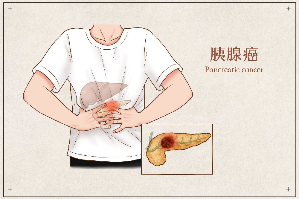 胡伟利主任：如何在饮食上预防胰腺癌的发生？