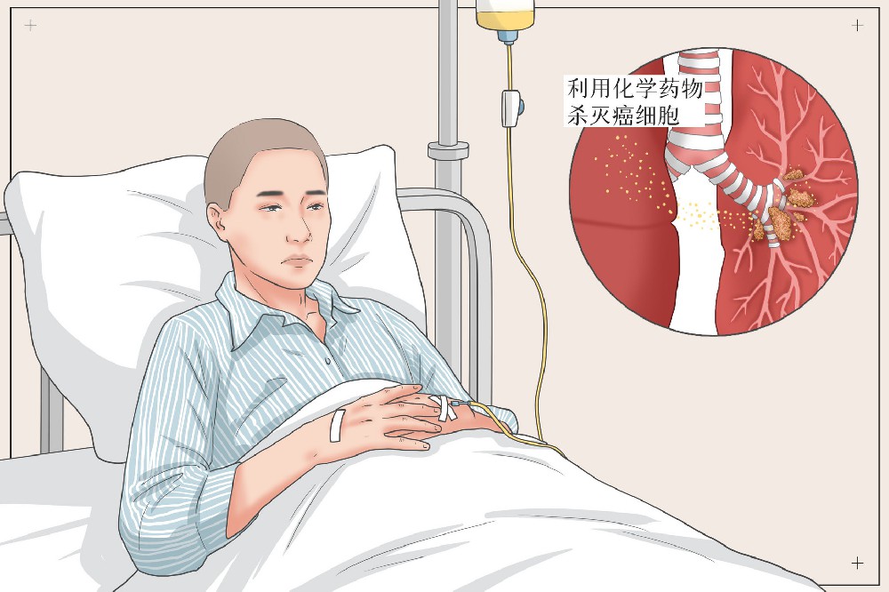 肺癌的早期症状不容忽视！