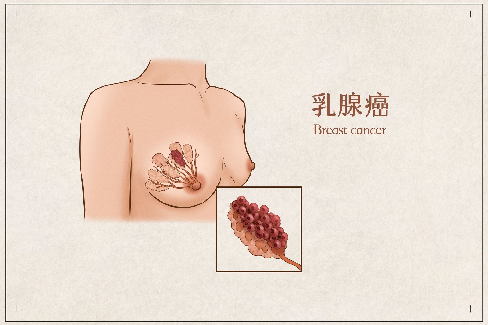 黄宏主任：哪些乳腺癌患者易发生转移？