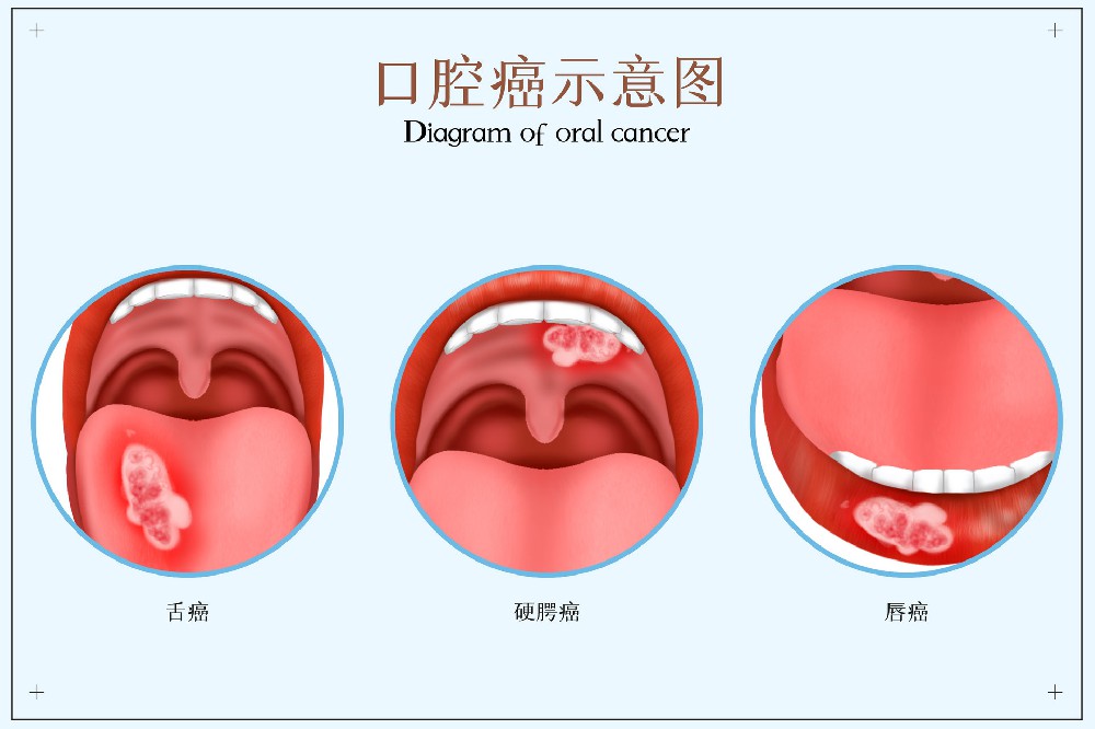 摄图网_401864870_banner_口腔癌医疗配图（企业商用）.jpg