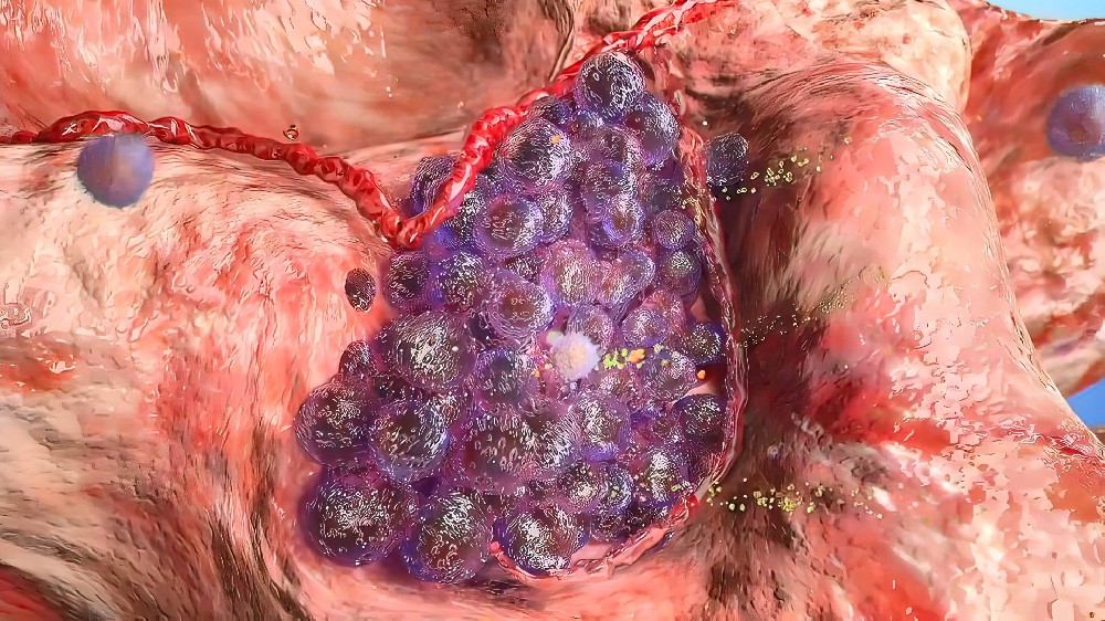 微浸润癌 vs 浸润癌，一字之差，治疗和预后天壤之别！治疗方向选对才关键