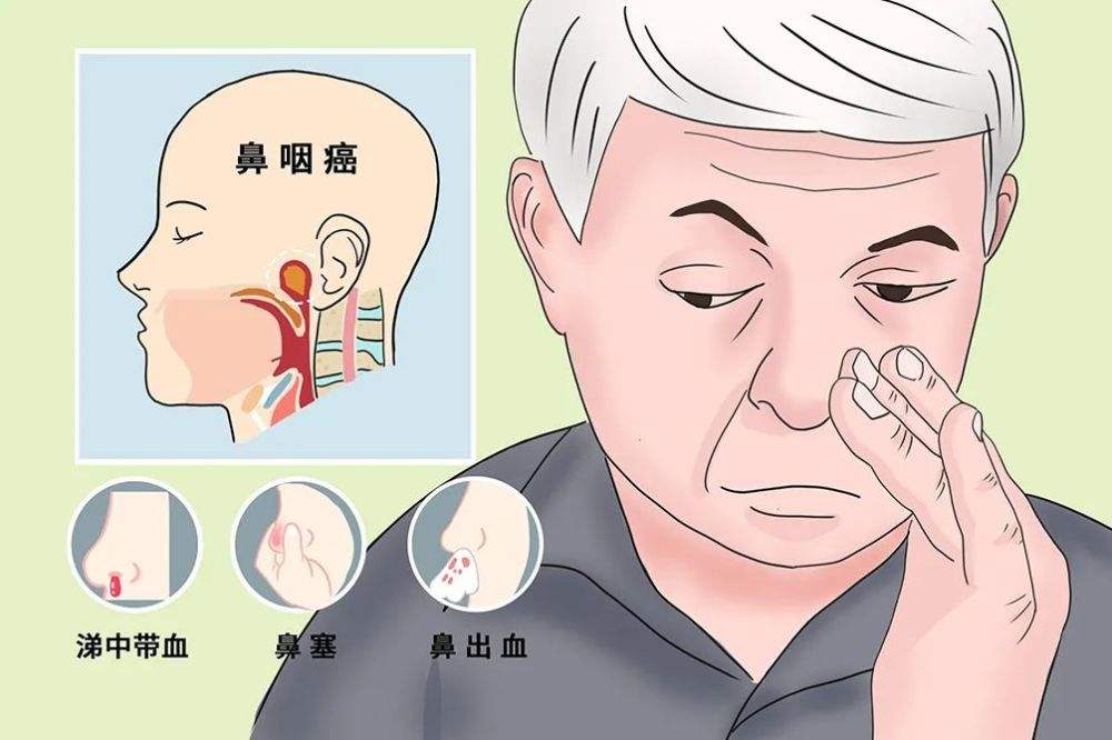 鼻咽癌需重视，中医防治妙招多