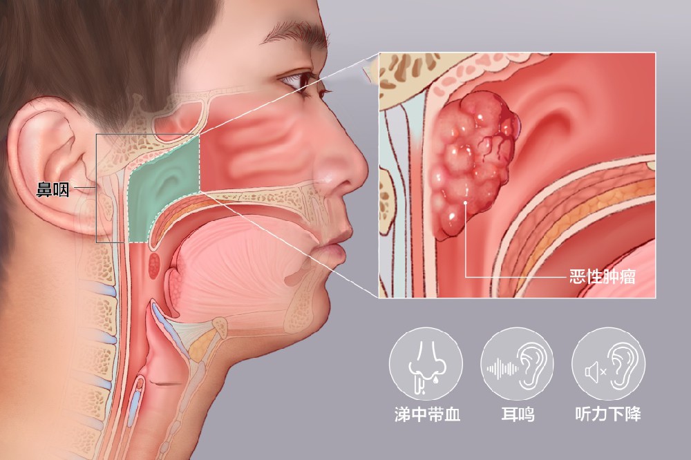 鼻咽癌如何预防？